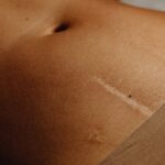 Retard de cicatrisation : quelles causes possibles et comment la photobiomodulation peut-elle accélérer la réparation des tissus ?