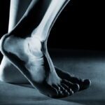 Fracture persistante : la photobiomodulation peut-elle accélérer la guérison ?